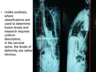 Cervical Spine Deformity 2019 | PPTX