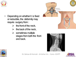 • Depending on whetherit is fixed
or reducible, the deformitymay
require surgery from :
 thefrontof the neck,
 theback of the neck,
 sometimes multiple
stages fromboththe front
and back.
Dr. Bahaa Ali Kornah - Al-Azhar Un. - Cairo- EGYPT
 