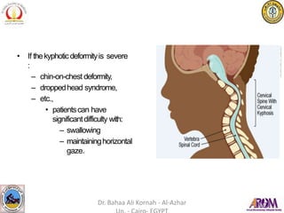 • If thekyphoticdeformityis severe
:
– chin-on-chest deformity,
– droppedhead syndrome,
– etc.,
• patientscan have
significantdifficulty with:
– swallowing
– maintaininghorizontal
gaze.
Dr. Bahaa Ali Kornah - Al-Azhar
 