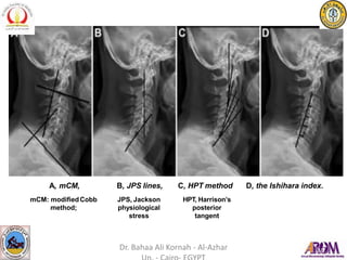 A, mCM,
mCM: modifiedCobb
method;
B, JPS lines,
JPS, Jackson
physiological
stress
C, HPT method
HPT, Harrison’s
posterior
tangent
D, the Ishihara index.
Dr. Bahaa Ali Kornah - Al-Azhar
 