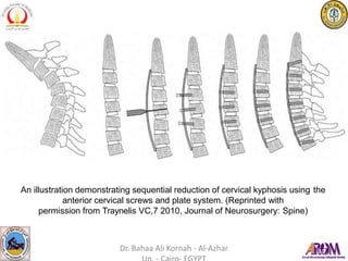 An illustration demonstrating sequential reduction of cervical kyphosis using the
anterior cervical screws and plate system. (Reprinted with
permission from Traynelis VC,7 2010, Journal of Neurosurgery: Spine)
Dr. Bahaa Ali Kornah - Al-Azhar
 