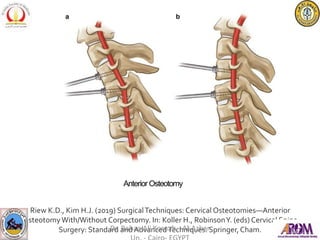 Anterior Osteotomy
Riew K.D., Kim H.J. (2019) SurgicalTechniques: Cervical Osteotomies—Anterior
OsteotomyWith/Without Corpectomy. In: Koller H., RobinsonY. (eds) Cervical Spine
Surgery: Standard and AdvancedTechniques. Springer,Cham.
Dr. Bahaa Ali Kornah - Al-Azhar
 