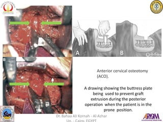 Anterior cervical osteotomy
(ACO).
A drawing showing the buttress plate
being used to prevent graft
extrusion during the posterior
operation when the patient is in the
prone position.
Dr. Bahaa Ali Kornah - Al-Azhar
 