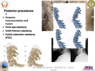 Posterior procedures
 Posterior
Instrumentation and
Fusion
 Pontetypeosteotomy
 Smith-Petersen osteotomy,
 Pediclesubtraction osteotomy
(PSO),
Ponte type osteotomy
Dr. Bahaa Ali Kornah - Al-Azhar Un. - Cairo-
 