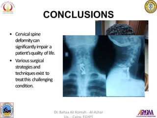 CONCLUSIONS
• Cervicalspine
deformitycan
significantlyimpair a
patient’squality oflife.
• Varioussurgical
strategiesand
techniquesexist to
treatthis challenging
condition.
Dr. Bahaa Ali Kornah - Al-Azhar
 