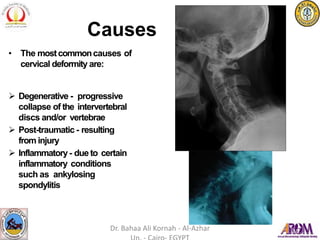 • The mostcommoncauses of
cervical deformity are:
 Degenerative - progressive
collapse of the intervertebral
discs and/or vertebrae
 Post-traumatic - resulting
from injury
 Inflammatory- due to certain
inflammatory conditions
such as ankylosing
spondylitis
Causes
Dr. Bahaa Ali Kornah - Al-Azhar
 