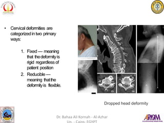 • Cervical deformities are
categorizedintwo primary
ways:
1. Fixed — meaning
that thedeformityis
rigid regardless of
patient position
2. Reducible —
meaning thatthe
deformityis flexible.
Dropped head deformity
Dr. Bahaa Ali Kornah - Al-Azhar
 