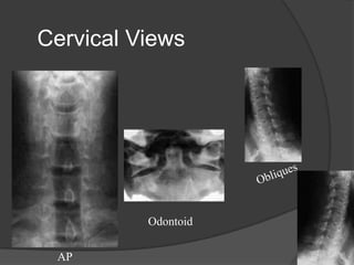 Cervical Views

Odontoid
AP

 
