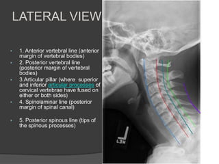 LATERAL VIEW









1. Anterior vertebral line (anterior
margin of vertebral bodies)
2. Posterior vertebral line
(posterior margin of vertebral
bodies)
3.Articular pillar (where superior
and inferior articular processes of
cervical vertebrae have fused on
either or both sides)
4. Spinolaminar line (posterior
margin of spinal canal)
5. Posterior spinous line (tips of
the spinous processes)

 