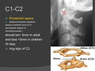 C1-C2


Predental space

(distance between posterior
aspect of anterior arch of C1
and anterior aspect of
odontoid process )


should be< 3mm In adult
and less <5mm in children
Or less
 ring sign of C2

 
