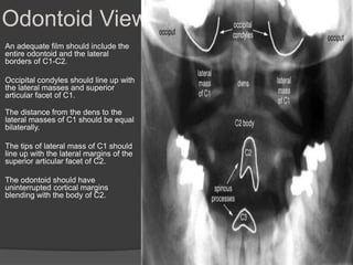 Odontoid View
An adequate film should include the
entire odontoid and the lateral
borders of C1-C2.
Occipital condyles should line up with
the lateral masses and superior
articular facet of C1.
The distance from the dens to the
lateral masses of C1 should be equal
bilaterally.

The tips of lateral mass of C1 should
line up with the lateral margins of the
superior articular facet of C2.
The odontoid should have
uninterrupted cortical margins
blending with the body of C2.

 