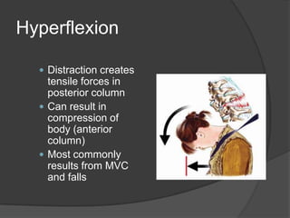 Hyperflexion
 Distraction creates

tensile forces in
posterior column
 Can result in
compression of
body (anterior
column)
 Most commonly
results from MVC
and falls

 