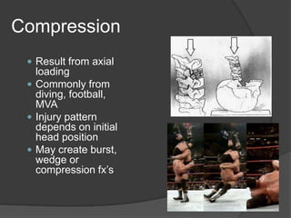 Compression
 Result from axial

loading
 Commonly from
diving, football,
MVA
 Injury pattern
depends on initial
head position
 May create burst,
wedge or
compression fx’s

 