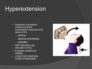 Hyperextension
 Impaction of posterior

arches and facet
compression causing many
types of fx’s
○ lamina

○ spinous processes
○ pedicles
 With distraction get

disruption of ALL
 Evaluate carefully for
stability
 LOOK FOR CENTRAL
CORD SYNDROME

 