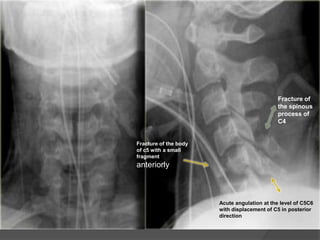 Fracture of
the spinous
process of
C4

Fracture of the body
of c5 with a small
fragment

anteriorly

Acute angulation at the level of C5C6
with displacement of C5 in posterior
direction

 