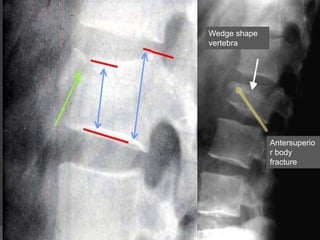 Wedge shape
vertebra

Antersuperio
r body
fracture

 