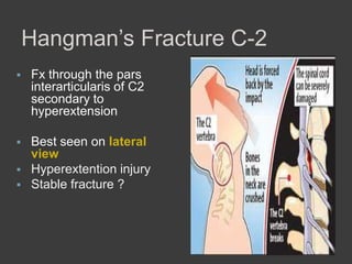Hangman’s Fracture C-2


Fx through the pars
interarticularis of C2
secondary to
hyperextension



Best seen on lateral
view
Hyperextention injury
Stable fracture ?




 