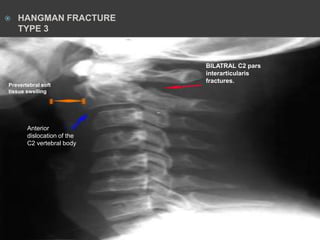 

HANGMAN FRACTURE
TYPE 3

Prevertebral soft
tissue swelling

Anterior
dislocation of the
C2 vertebral body

BILATRAL C2 pars
interarticularis
fractures.

 