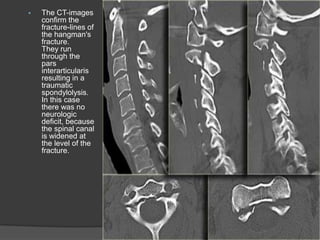 

The CT-images
confirm the
fracture-lines of
the hangman's
fracture.
They run
through the
pars
interarticularis
resulting in a
traumatic
spondylolysis.
In this case
there was no
neurologic
deficit, because
the spinal canal
is widened at
the level of the
fracture.

 