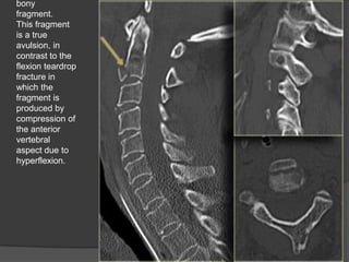 bony
fragment.
This fragment
is a true
avulsion, in
contrast to the
flexion teardrop
fracture in
which the
fragment is
produced by
compression of
the anterior
vertebral
aspect due to
hyperflexion.

 