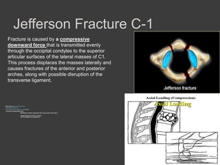 Jefferson Fracture C-1
Fracture is caused by a compressive
downward force that is transmitted evenly
through the occipital condyles to the superior
articular surfaces of the lateral masses of C1.
This process displaces the masses laterally and
causes fractures of the anterior and posterior
arches, along with possible disruption of the
transverse ligament.

•
•
•
•

Best seen on odontoid view
Unstable fracture
Fracture due to AXIAL LOADING
frequently associated with
•
diving into shallow water(axial
•
•

blow to the vertex of the head )

impact against the roof of a vehicle
fall from playground equipments

 
