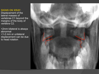SIGNS ON XRAY:
Displacement of the
lateral masses of
vertebrae C1 beyond the
margins of the body of
vertebra C2.
<2mm bilateral is always
abnormal
<1-2 mm or unilateral
displacement can be due
to head rotation

 