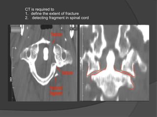 CT is required to
1. define the extent of fracture
2. detecting fragment in spinal cord

 