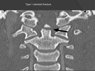 Type 1 odontoid fracture

 