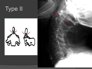 Type II

 