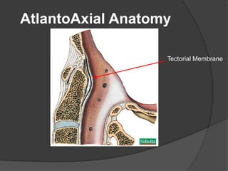 AtlantoAxial Anatomy
Tectorial Membrane

 