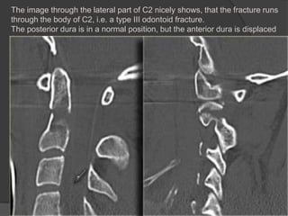 The image through the lateral part of C2 nicely shows, that the fracture runs
through the body of C2, i.e. a type III odontoid fracture.
The posterior dura is in a normal position, but the anterior dura is displaced
(arrow).

 
