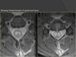 Showing Central location of spinal cord injury

 