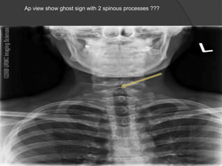 Ap view show ghost sign with 2 spinous processes ???

 