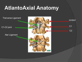 AtlantoAxial Anatomy
Tranverse Ligament
occiput

C1-C2 joint

C1
C2

Alar Ligament

 