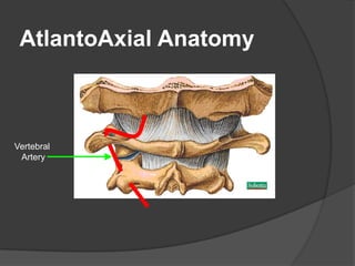 AtlantoAxial Anatomy

Vertebral
Artery

 