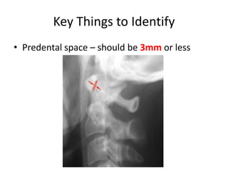 Key Things to Identify
• Predental space – should be 3mm or less
 