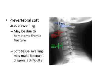 • Prevertebral soft
tissue swelling
– May be due to
hematoma from a
fracture
– Soft tissue swelling
may make fracture
diagnosis difficulty
 