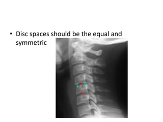 • Disc spaces should be the equal and
symmetric
 