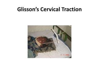 Glisson’s Cervical Traction
 