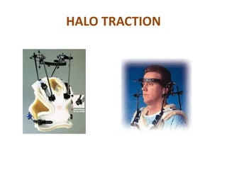 HALO TRACTION
 