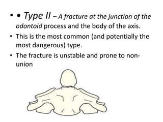 • • Type II – A fracture at the junction of the
odontoid process and the body of the axis.
• This is the most common (and potentially the
most dangerous) type.
• The fracture is unstable and prone to non-
union
 