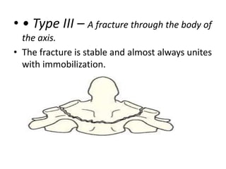 • • Type III – A fracture through the body of
the axis.
• The fracture is stable and almost always unites
with immobilization.
 