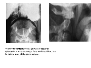 Fractured odontoid process (a) Anteroposterior
‘open-mouth’ x-ray showing a Type II odontoid fracture.
(b) Lateral x-ray of the same patient.
 