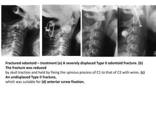 Fractured odontoid – treatment (a) A severely displaced Type II odontoid fracture. (b)
The fracture was reduced
by skull traction and held by fixing the spinous process of C1 to that of C2 with wires. (c)
An undisplaced Type II fracture,
which was suitable for (d) anterior screw fixation.
 
