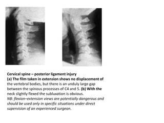 Cervical spine – posterior ligament injury
(a) The film taken in extension shows no displacement of
the vertebral bodies, but there is an unduly large gap
between the spinous processes of C4 and 5. (b) With the
neck slightly flexed the subluxation is obvious.
NB: flexion–extension views are potentially dangerous and
should be used only in specific situations under direct
supervision of an experienced surgeon.
 