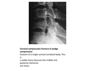 Cervical compression fracture A wedge
compression
fracture of a single cervical vertebral body. This
is
a stable injury because the middle and
posterior elements
are intact.
 