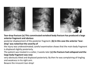 Tear-drop fracture (a) This comminuted vertebral body fracture has produced a large
anterior fragment and obvious
posterior displacement of the posterior fragment. (b) In this case the anterior ‘tear-
drop’ was noted but the severity of
the injury was underestimated; careful examination shows that the main body fragment
is displaced slightly posteriorly.
The patient was treated in a collar; 3 weeks later (c) the fracture had collapsed and the
large body fragment was now
very obviously tilted and displaced posteriorly. By then he was complaining of tingling
and weakness in his right arm.
Beware the innocent tear-drop!
 
