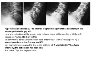 Hyperextension injuries (a) The anterior longitudinal ligament has been torn; in the
neutral position the gap will
close and reduction will be stable, but a collar or brace will be needed until the soft
tissues are healed. (b) X-ray in this
case showed a barely visible flake of bone anteriorly at the C6/7 disc space. (c) 1
month later the traction fracture at C6/7
was more obvious, as was the disc lesion at C5/6. (d) A year later C6/7 has fused
anteriorly; the patient still has neck pain
due to the C5/6 disc degeneration.
 