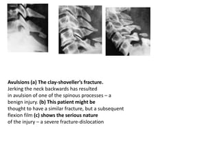Avulsions (a) The clay-shoveller’s fracture.
Jerking the neck backwards has resulted
in avulsion of one of the spinous processes – a
benign injury. (b) This patient might be
thought to have a similar fracture, but a subsequent
flexion film (c) shows the serious nature
of the injury – a severe fracture-dislocation
 