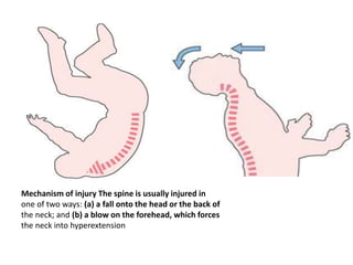Mechanism of injury The spine is usually injured in
one of two ways: (a) a fall onto the head or the back of
the neck; and (b) a blow on the forehead, which forces
the neck into hyperextension
 
